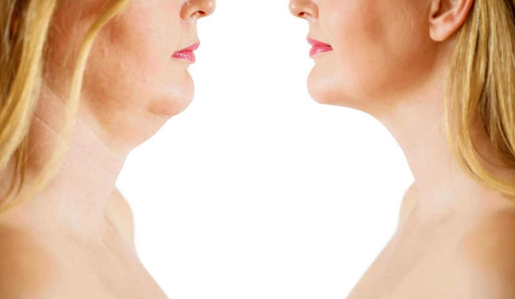 Double Chin treatment Cannock before and after results