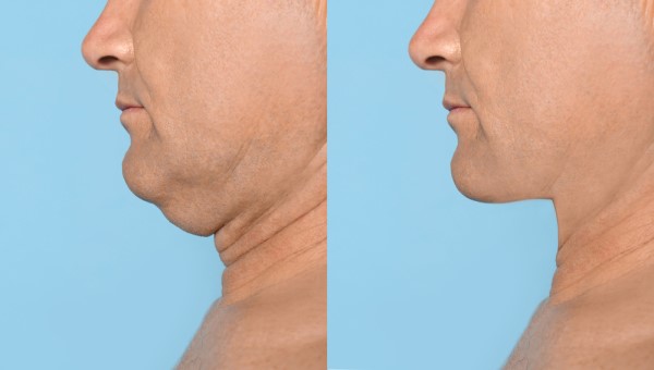 Which Non-Surgical Treatments Work Best for Jowls and Loose Skin Cannock?