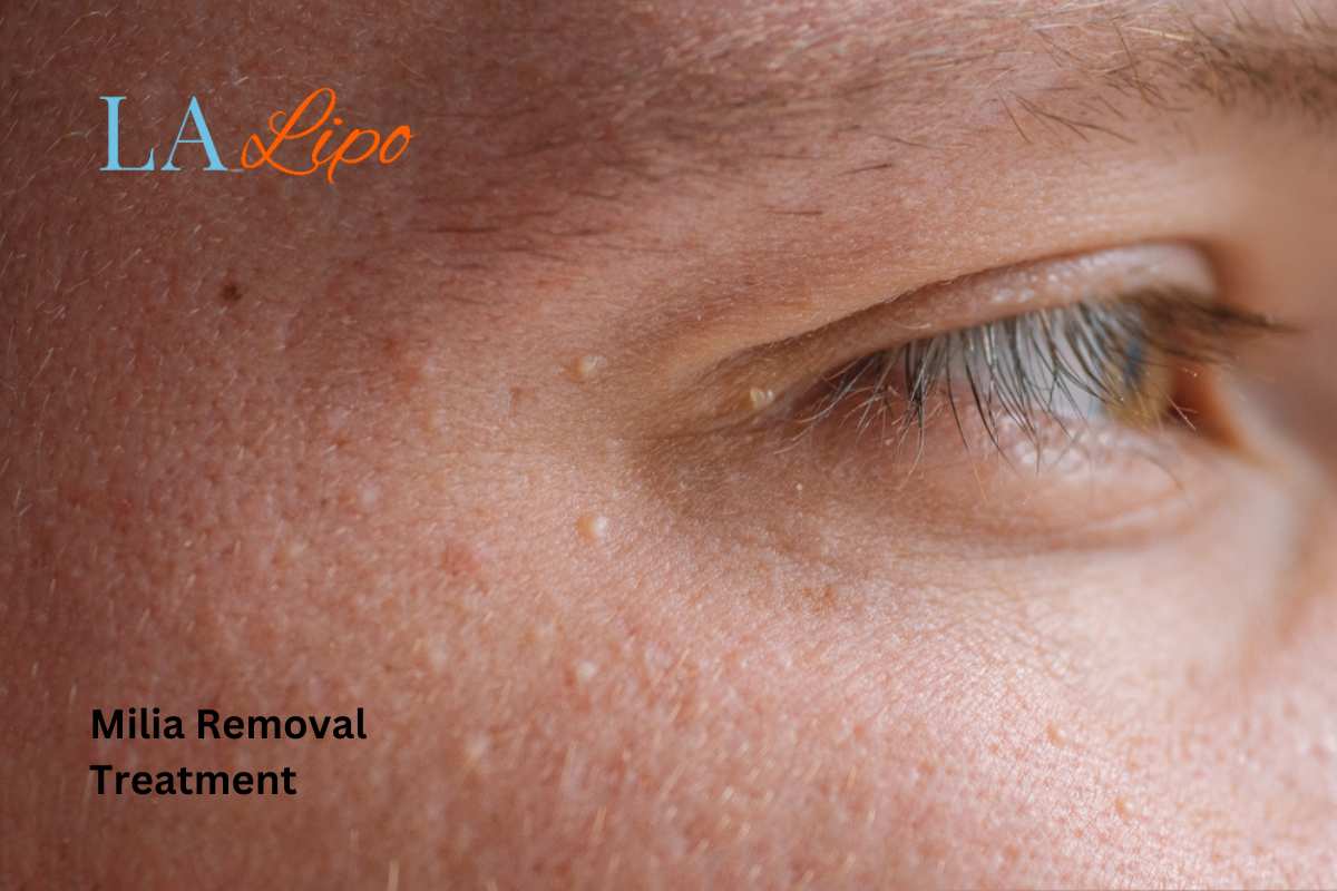 Cryopen Milia Removal: Is It the Easiest and Safest Option Cannock?