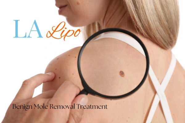 Why getting moles removed Cannock can boost your confidence!