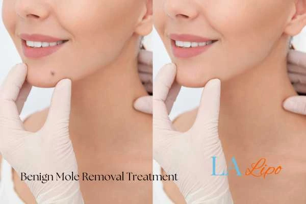 woman's before and after mole removal Cannock results