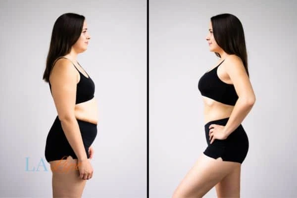 image of woman before and after results of LA-EMS Body Sculpting Cannock to help treat Diastasis recti