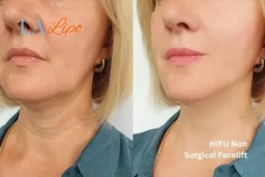 hi-fu for wrinkles Cannock before and after results
