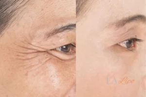 Before and after results of woman - HI-fu wrinkles reduction treatment Cannock