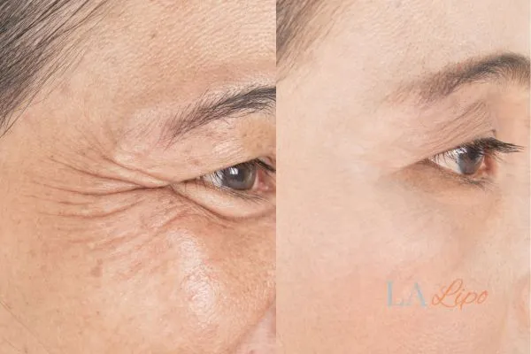 Before and after results of woman - HI-fu wrinkles reduction treatment Cannock