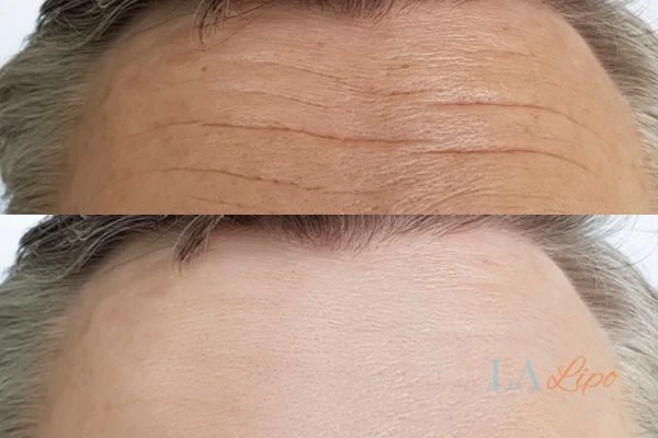 results of HIFU Cannock on mans forehead to help reduce lines and wrinkles