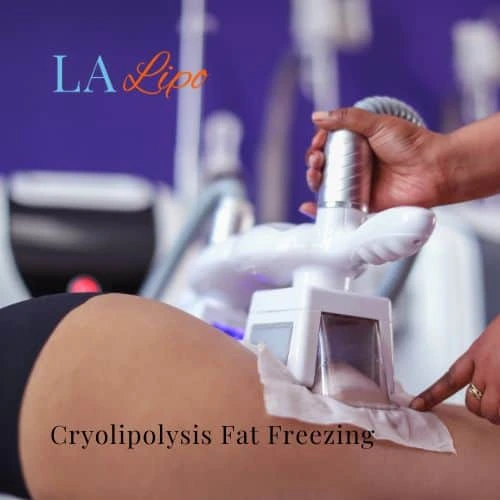 fat freezing - Cryolipolysis Cannock