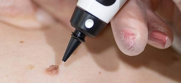 skin tag removal using cryopen Cannock