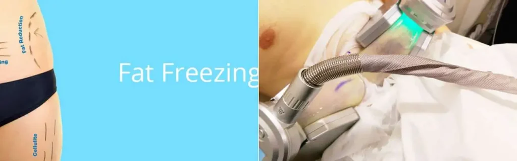 Fat freezing Cannock on multiple areas of the body