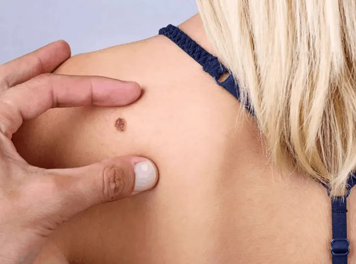 woman having mole removal Cannock consultation before treatment.