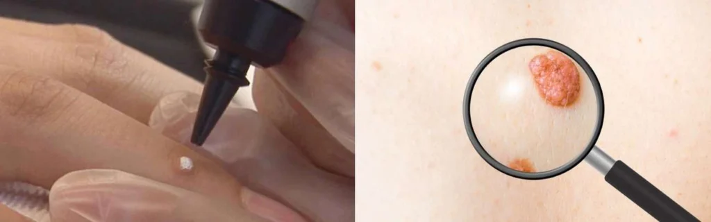 Person getting moles removed with cryopen Cannock