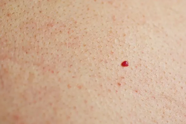 close up of a cherry angioma Cannock