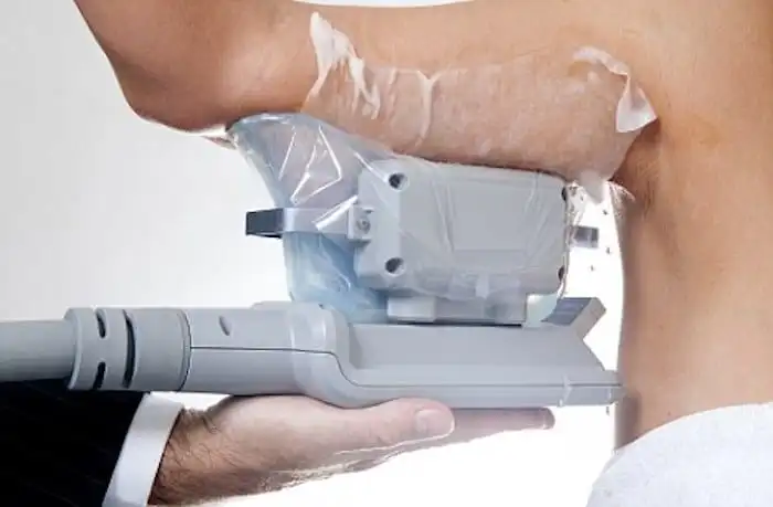 Picture of fat freezing Cannock on the upper arms.