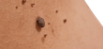 image of a skin tag Cannock