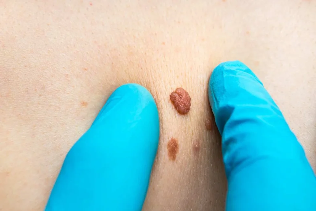 Consultant examining a skin tag Cannock