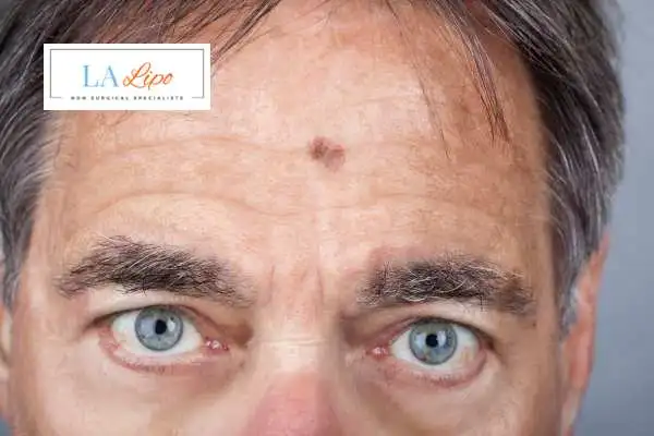 Solar Lentigo Removal Cannock image of man with mark on his forehead