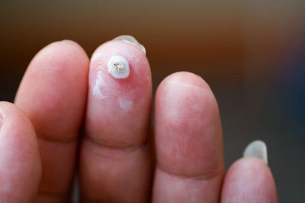 wart on person finger - cryotherapy to treat from LA LIPO Cannock