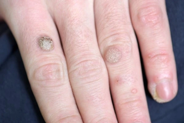 photo of warts on person hand - see wart removal Cannock from LA LIPO