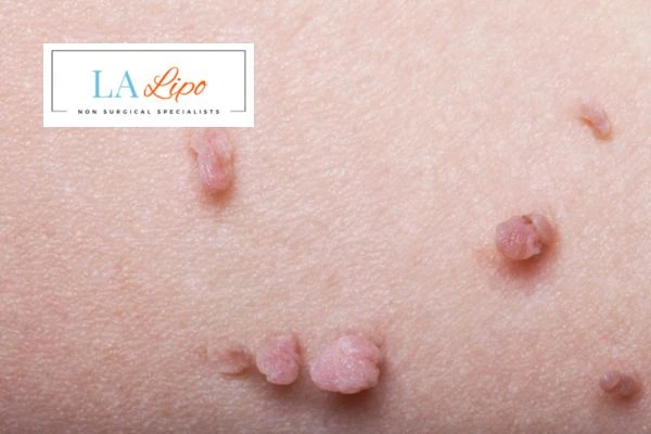 Does cryopen skin tag removal Cannock hurt? Find out now call our team today!