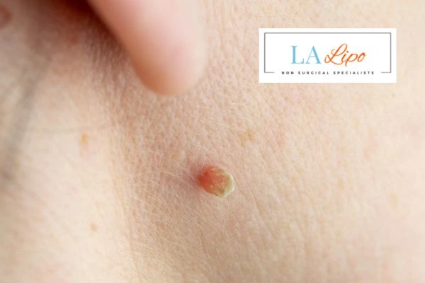 Book skin tag removal Cannock today speak to our team now!