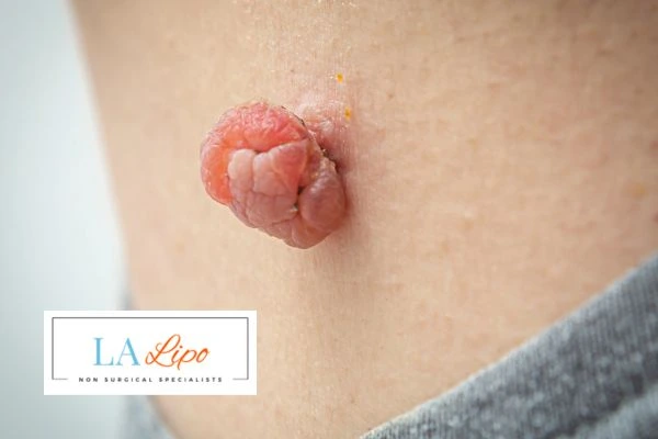 Interested in skin tag removal Cannock? Concerned about the pain? Find out more today!