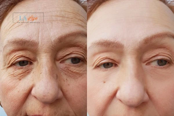 The powerful benefits of Morpheus8 Treatment Cannock - Call Our team today!