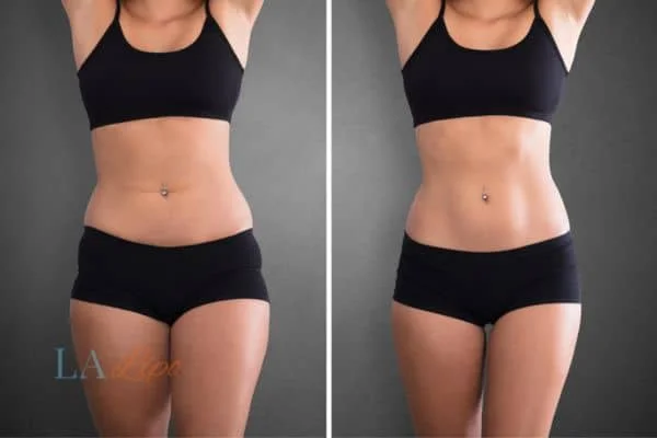 before and after results of non-surgical treatment to help a woman's body image and mental health Cannock