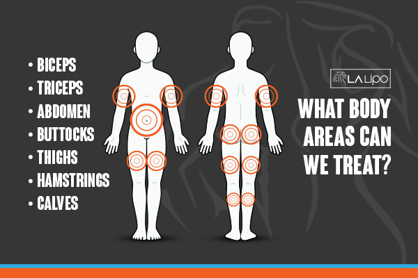 Diagram to show areas you can have LA-EMS Body Sculpting Treatment Cannock