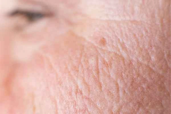close up picture of a woman's face showing an age spot Cannock