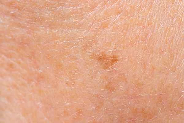 close up picture of age spots Cannock