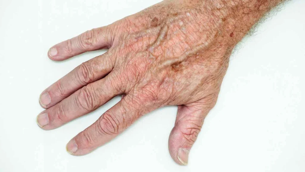 Male hand showing age spot Cannock