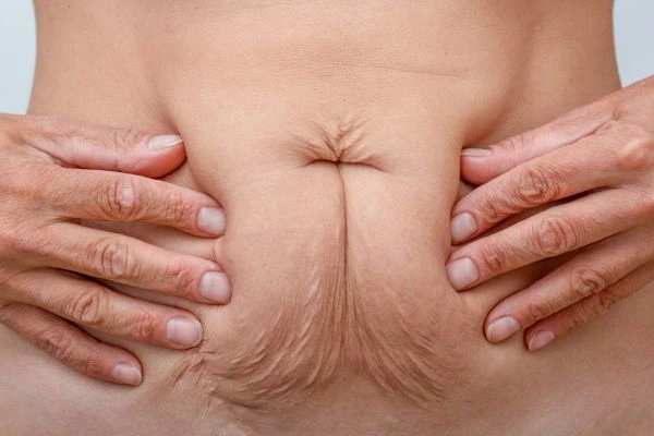 Image of a woman's stomach with loose skin - example of skin tightening Cannock options