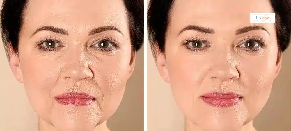 How Long Does It Take to See Results and How Long Do They Last Cannock?