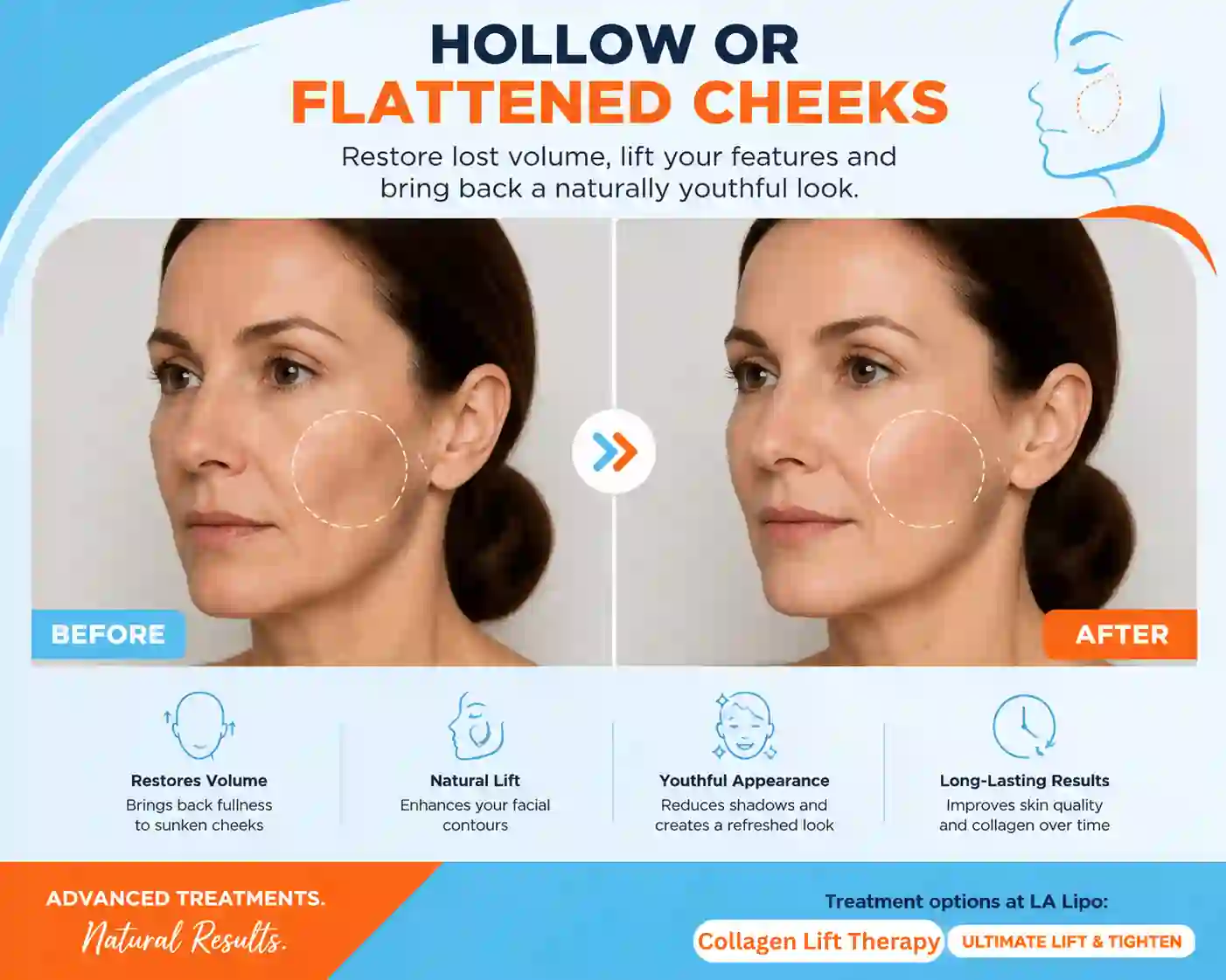 Sign #4: Hollow or Flattened Cheeks Cannock